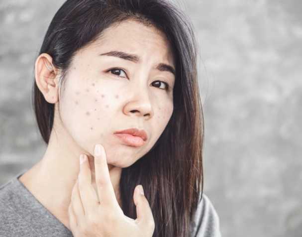 谷胱甘肽与痤疮严重程度的相关性